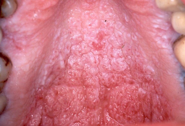 Nicotine Stomatitis - Clinical, Histological Features and Treatment