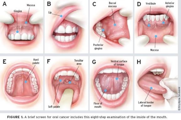 Hepatitis C linked to increased Oral Cancer cases