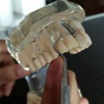 types-of-finger-rests-in-dentistry-and-periodontics