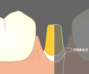 what is ferrule effect and types of ferrules in dentistry
