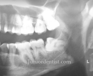 Care or Tips after Impacted Wisdom tooth extraction