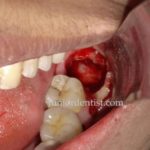 Impacted Wisdom tooth removal tips to control pain and bleeding