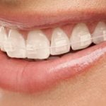 How to prevent Discoloration of Ceramic Braces