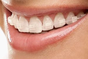 How to prevent Discoloration of Ceramic Braces
