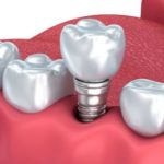 What to do if Crown on Dental Implant becomes Loose