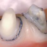 Gingival Retraction Methods and materials used