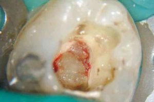 Dental Pulp Stones
