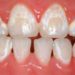 yellow or white stains on teeth after braces