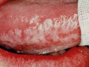 Classification of Oral lesions in HIV Infection or AIDS