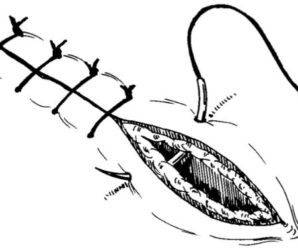 Suturing Techniques in Dentistry