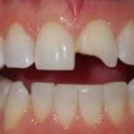 Traumatic injuries of teeth