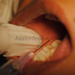 Failure of Inferior alveolar nerve block or hot tooth
