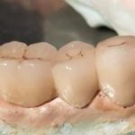 Classification of Fixed Partial Dentures