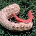 Types of Orthodontic Retainers - Fixed and Removable