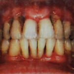 Periodontal Disease linked to Stomach and Oesophageal Cancers