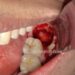 how many days does it take for extraction socket to heal wisdom tooth extraction