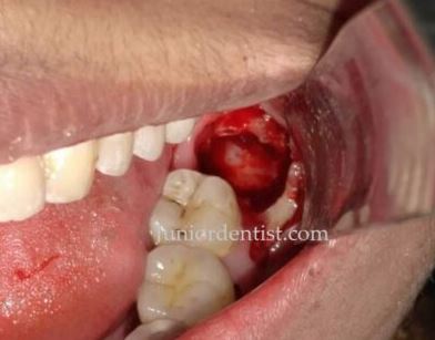 how many days does it take for extraction socket to heal wisdom tooth extraction