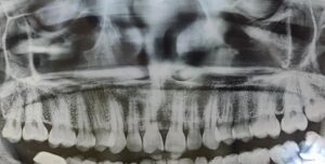 Radiographic Features of Diseases of Maxillary Sinus
