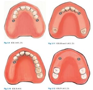 Implant Corrected Kennedy Classification