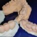 Indications and Contraindications of Fixed Partial Dentures