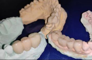 Indications and Contraindications of Fixed Partial Dentures