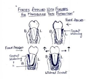 Forces Applied for Mandibular tooth Extraction with Forceps