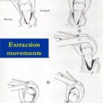 Mandibular Forceps movements for tooth extraction