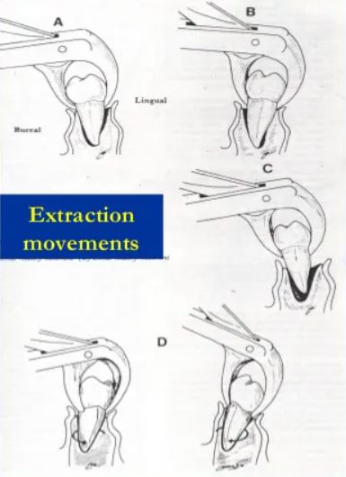 Mandibular Forceps movements for tooth extraction
