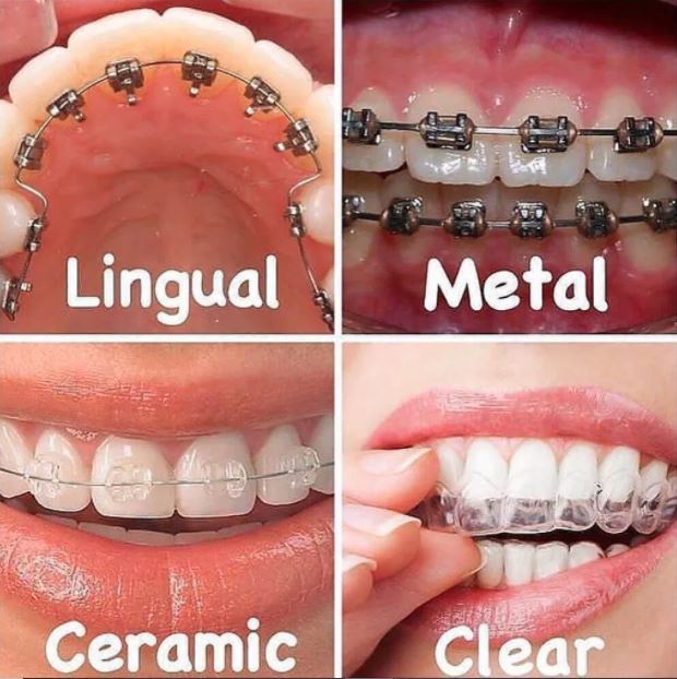 Types of Dental Braces 