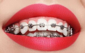 Dental Braces and Water Sports