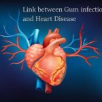 Link between Gum infection and Heart Disease