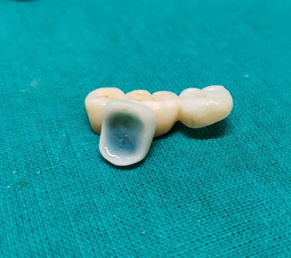 How to Bond Zirconia Crown to Tooth